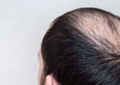 De mest almindelige årsager til hårtab