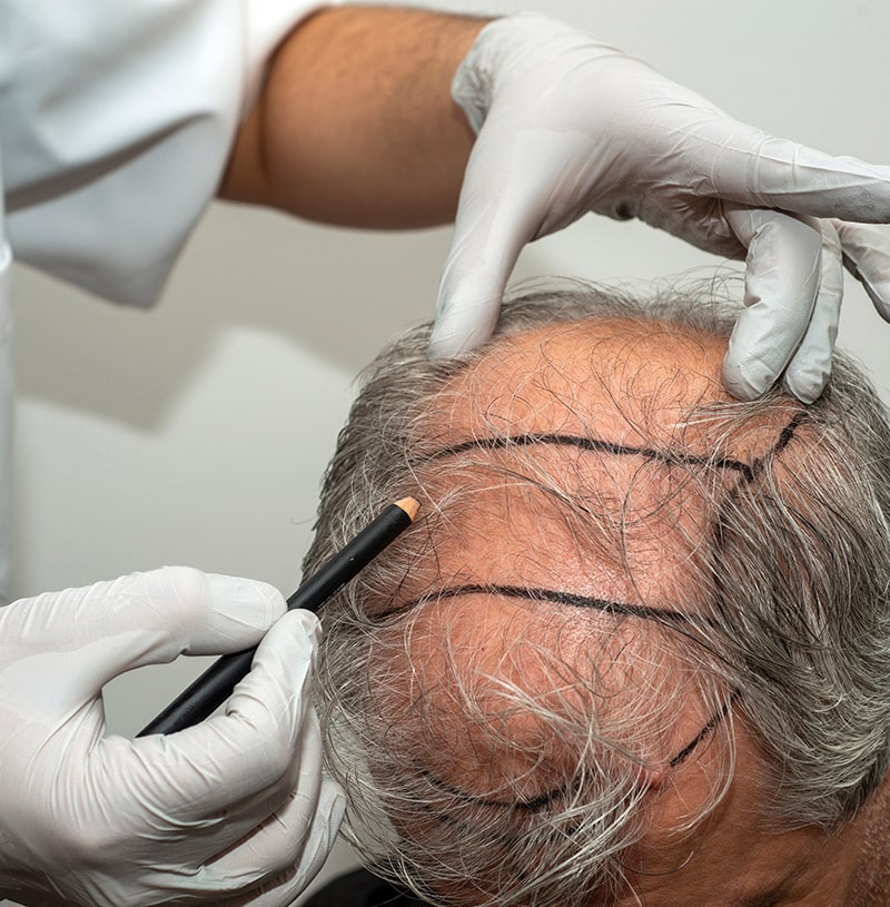 Scalp Micropigmentation (SMP) er en behandling der efterligner udseendet af naturlige hårsække.
